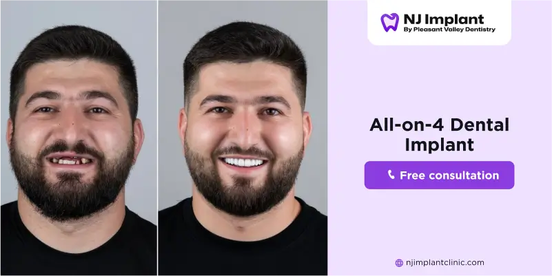 How to Care for your All on 4 Dental Implants