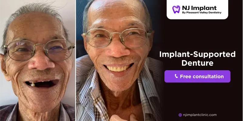 Implant-supported dentures